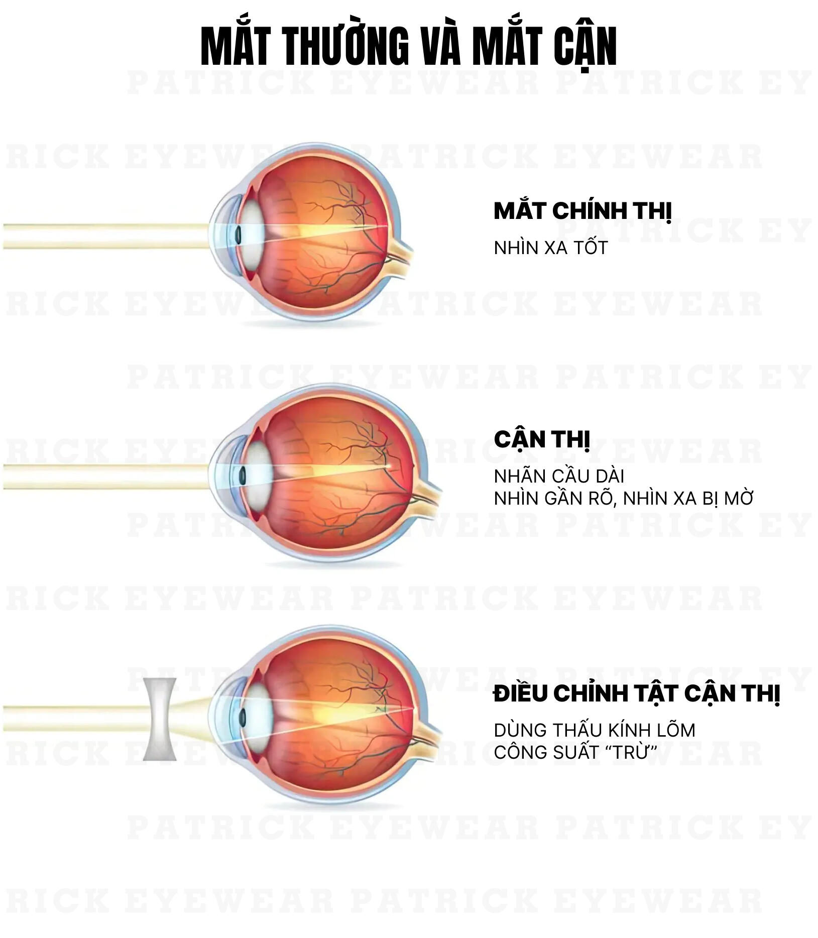 cận thị đeo kính gì