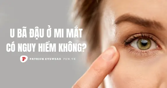 U bã đậu ở mi mắt: Nguyên nhân và cách điều trị