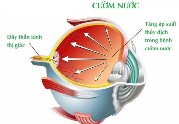 Cườm nước là gì, có mổ được không