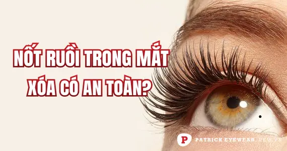 Nốt ruồi trong mắt có xóa được không?