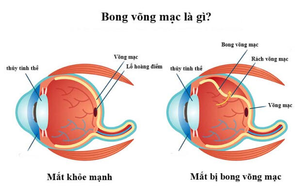 Bong võng mạc: Nguyên nhân và cách điều trị