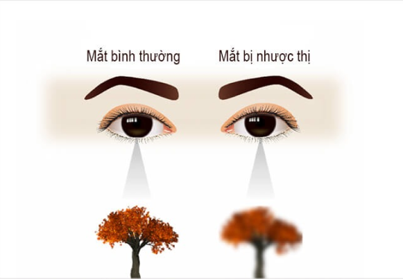 Có nên đeo kính thấp hơn độ cận