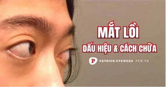 Mắt lồi: Nguyên nhân, triệu chứng và cách điều trị