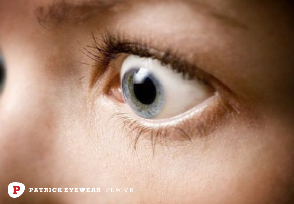 mắt lồi là gì  Mắt lồi: Nguyên nhân, triệu chứng và cách điều trị