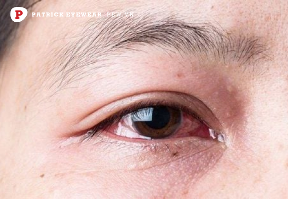 triệu chứng của mắt lồi là gì  Mắt lồi: Nguyên nhân, triệu chứng và cách điều trị