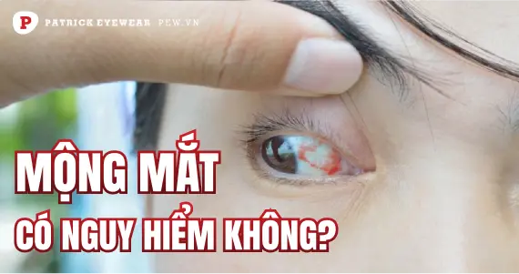 Mộng mắt có nguy hiểm không, bao lâu khỏi?