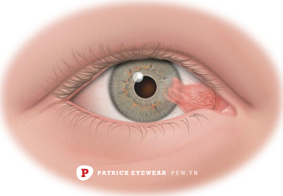 mộng mắt là gì Mộng mắt có nguy hiểm không, bao lâu khỏi