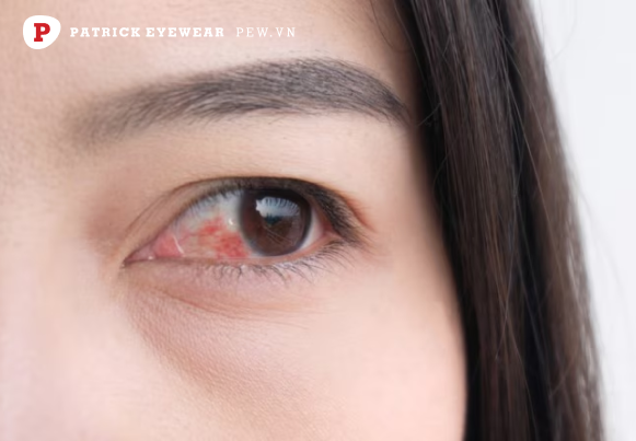 triệu chứng của mộng mắt Mộng mắt có nguy hiểm không, bao lâu khỏi