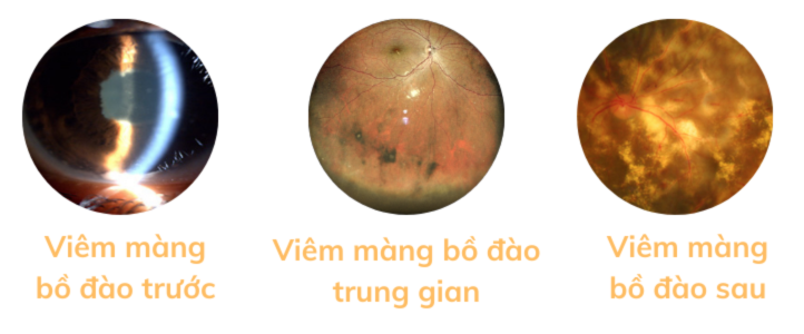 Viêm màng bồ đào có nguy hiểm không, bao lâu khỏi