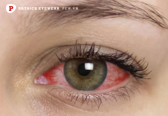 Viêm màng bồ đào có nguy hiểm không, bao lâu khỏi