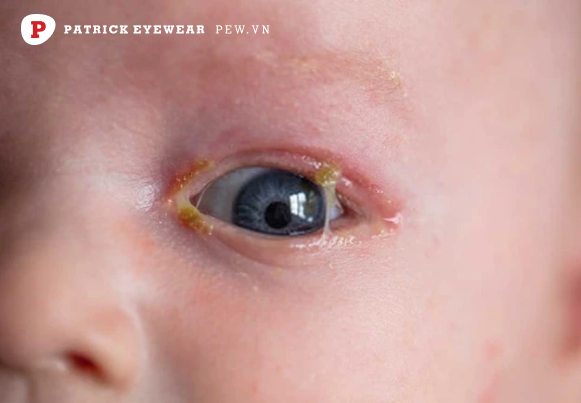 Viêm kết mạc mắt ở trẻ sơ sinh có nguy hiểm không, bao lâu khỏi