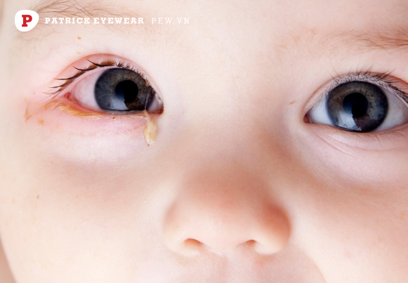 Viêm kết mạc mắt ở trẻ sơ sinh có nguy hiểm không, bao lâu khỏi
