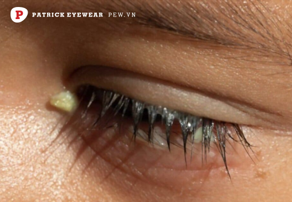 ngứa mắt trái cảnh báo bệnh lý về mắt Ngứa mắt trái là điềm gì, ngứa theo giờ có nguy hiểm không