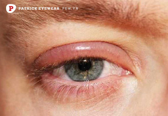 ngứa mắt trái cảnh báo bệnh lý về mắt Ngứa mắt trái là điềm gì, ngứa theo giờ có nguy hiểm không