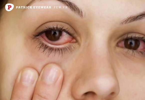 mắt cộm có nguy hiểm không Mắt bị cộm: Nguyên nhân và cách điều trị hiệu quả