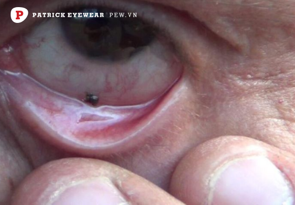 cộm mắt có nguy hiểm không Mắt bị cộm: Nguyên nhân và cách điều trị hiệu quả