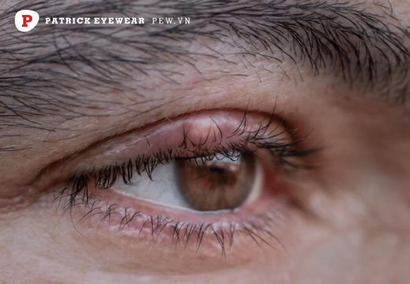 Mắt bị cộm: Nguyên nhân và cách điều trị hiệu quả