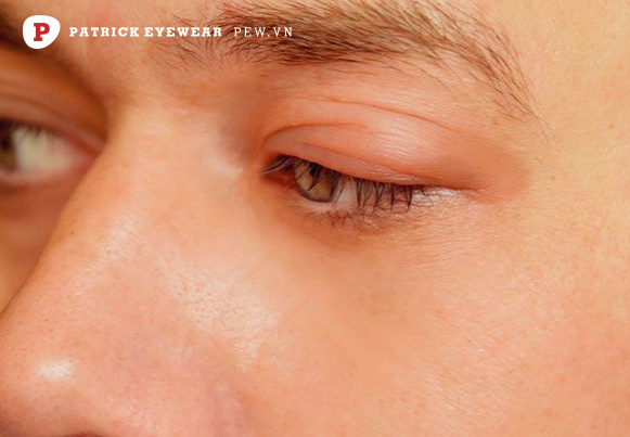 nguyên nhân đeo kính cận bị nhỏ Đeo kính cận mắt bị nhỏ phải làm sao