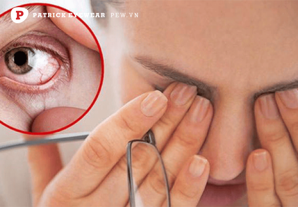 Nguyên nhân và cách trị dứt điểm ngứa khóe mắt