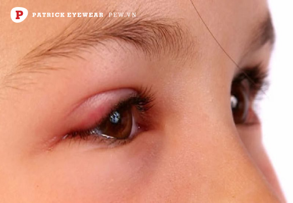 Nguyên nhân và cách trị dứt điểm ngứa khóe mắt