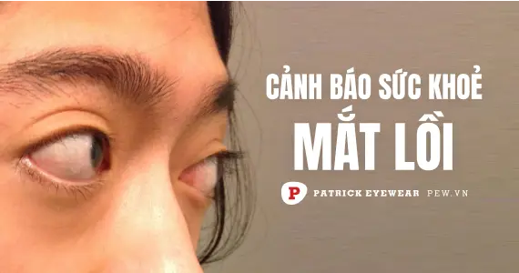 Mắt lồi: Nguyên nhân, triệu chứng và cách điều trị