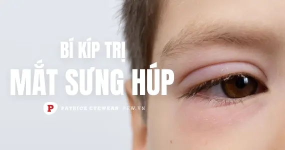Mắt bị sưng húp phải làm sao?