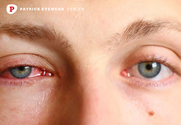 Mắt bị sưng húp phải làm sao