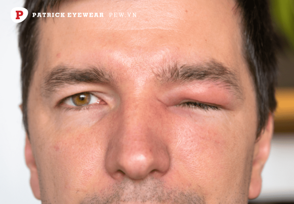 Mắt bị sưng húp phải làm sao