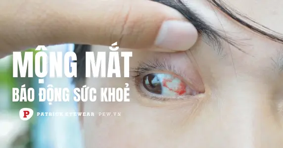 Mộng mắt có nguy hiểm không, bao lâu khỏi?